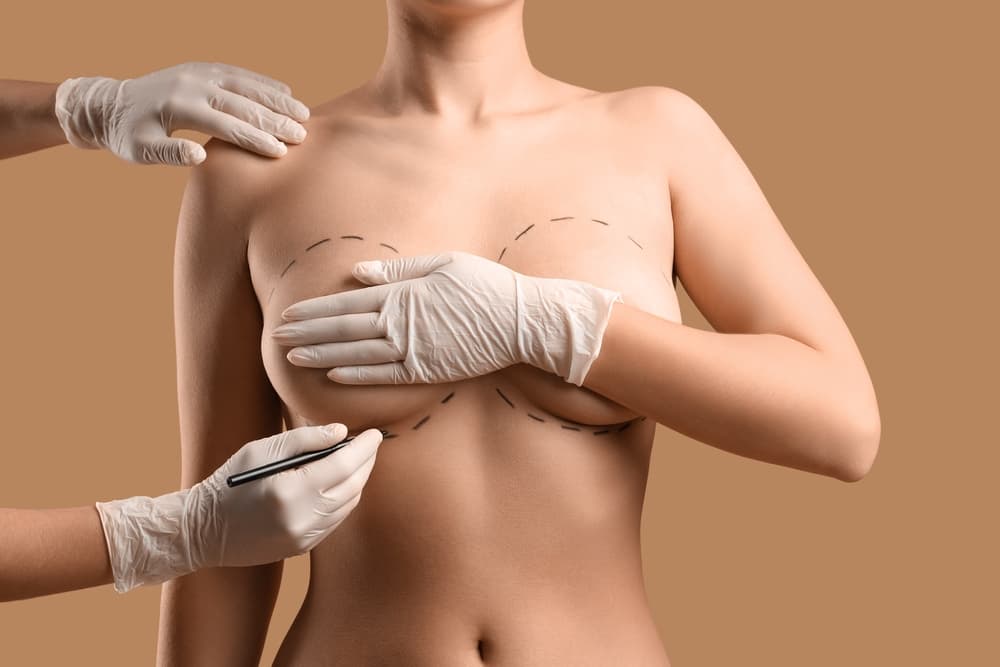 Breast Lift (Mastopexy)