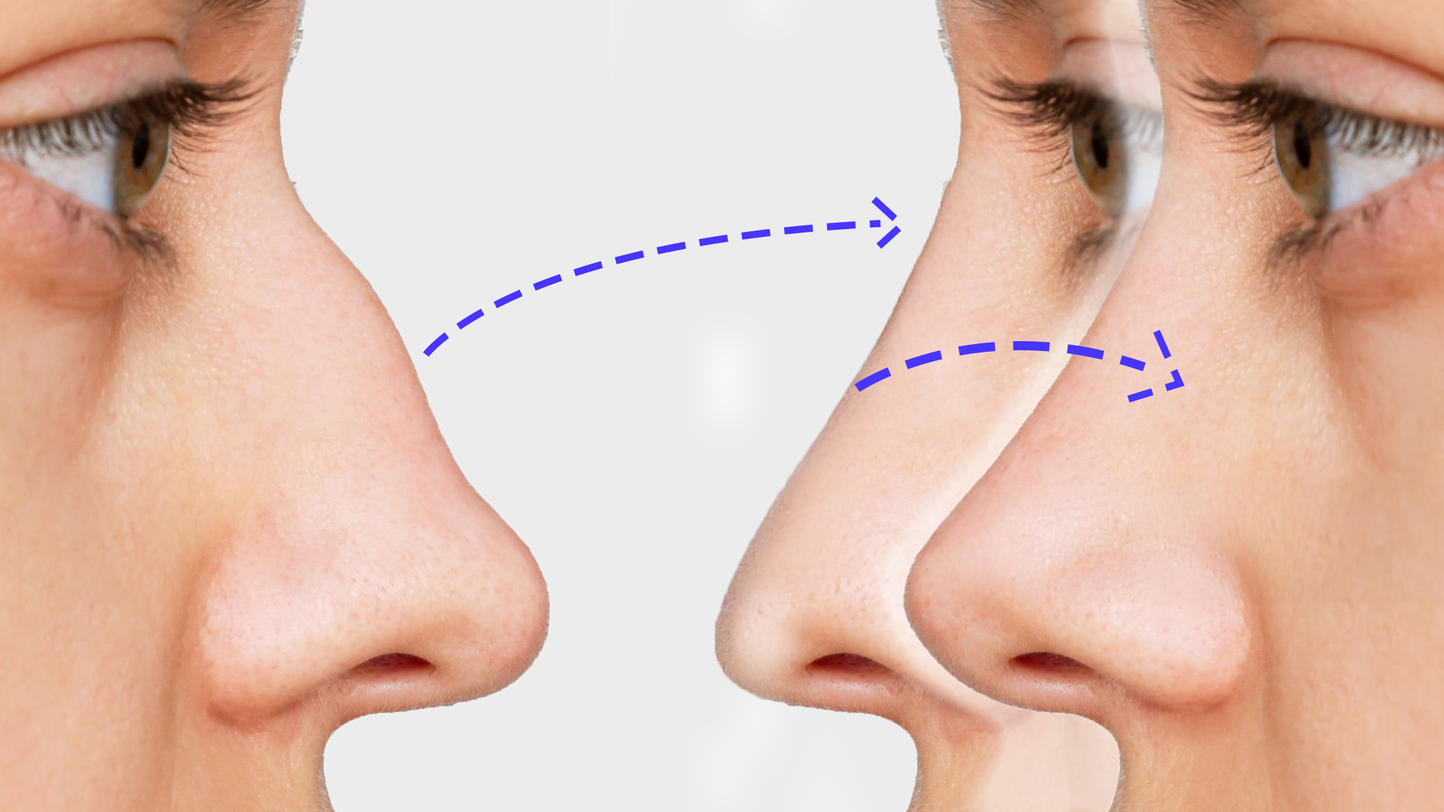 revizyon_rinoplasti_1.png